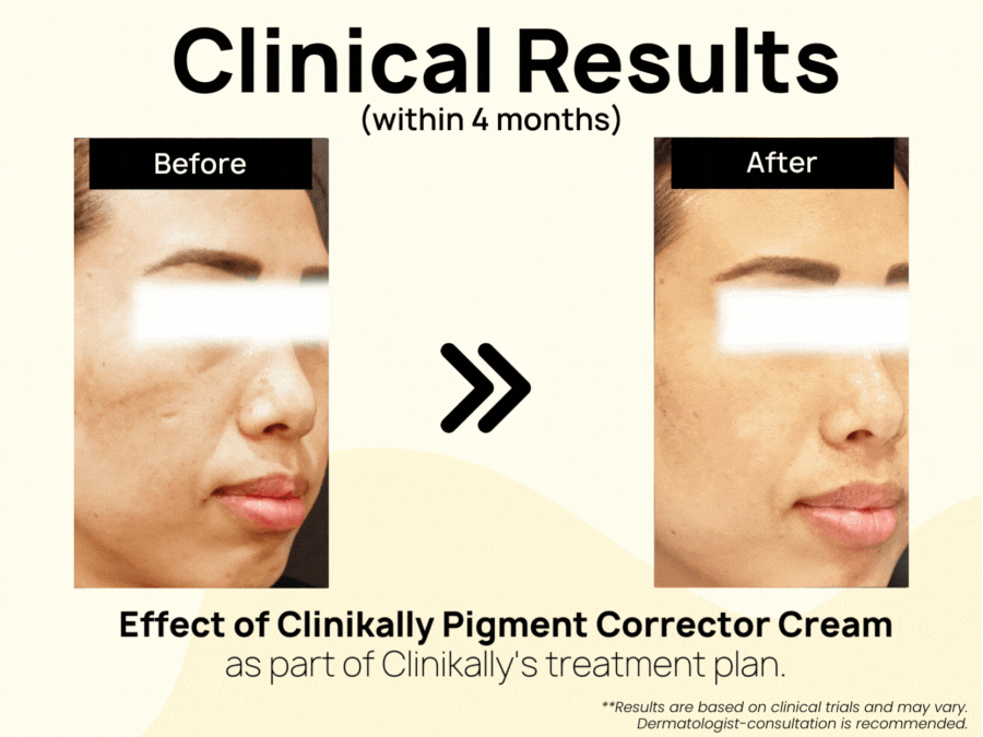 Clinikally Pigment Corrector Cream - Image 7