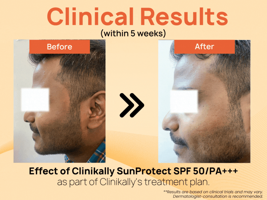 Clinikally SunProtect Sunscreen SPF 50/PA+++ - Image 7