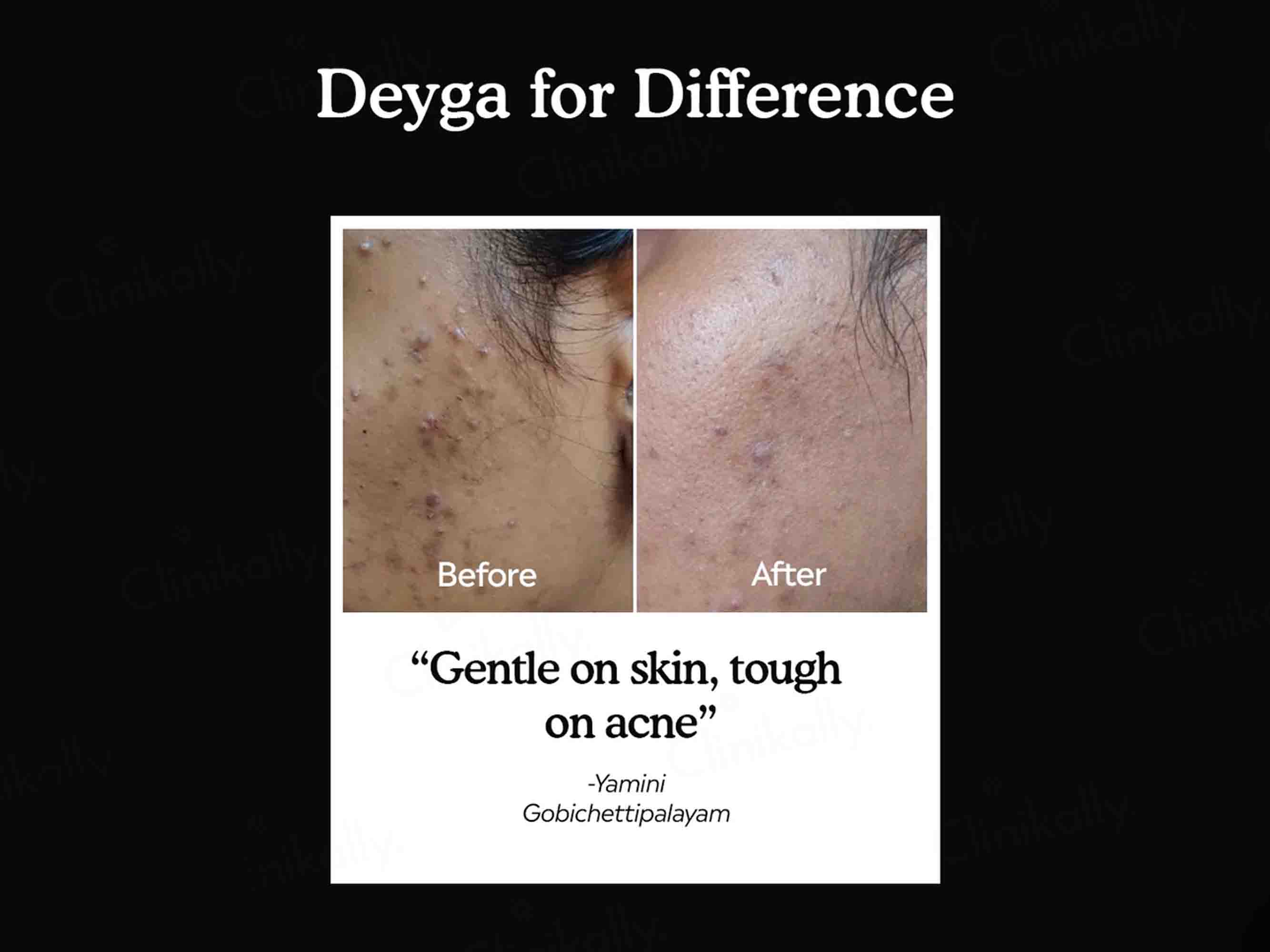 Deyga Charcoal Bath Bar For Acne Control & De-Tan - Image 4
