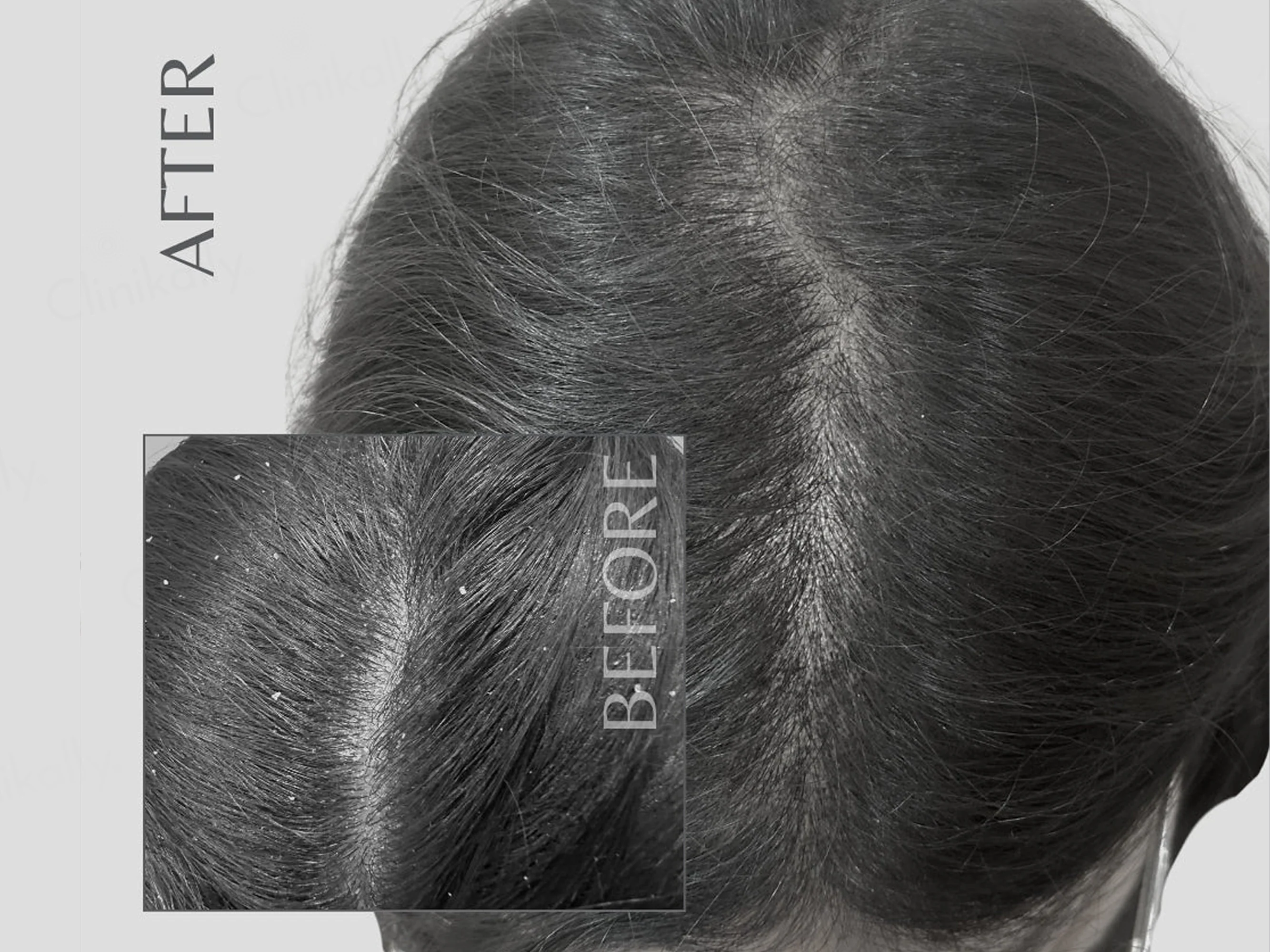 EnagenBio Degrease Pro Anti-Dandruff Scalp Serum - Image 8