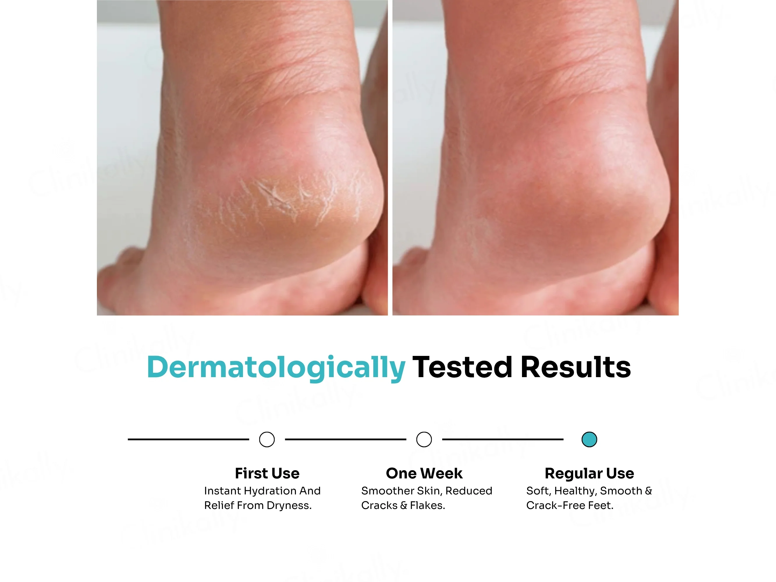 Kitcoz Foot Cream Roll-On For Cracked Heels & Diabetic Foot - Image 3