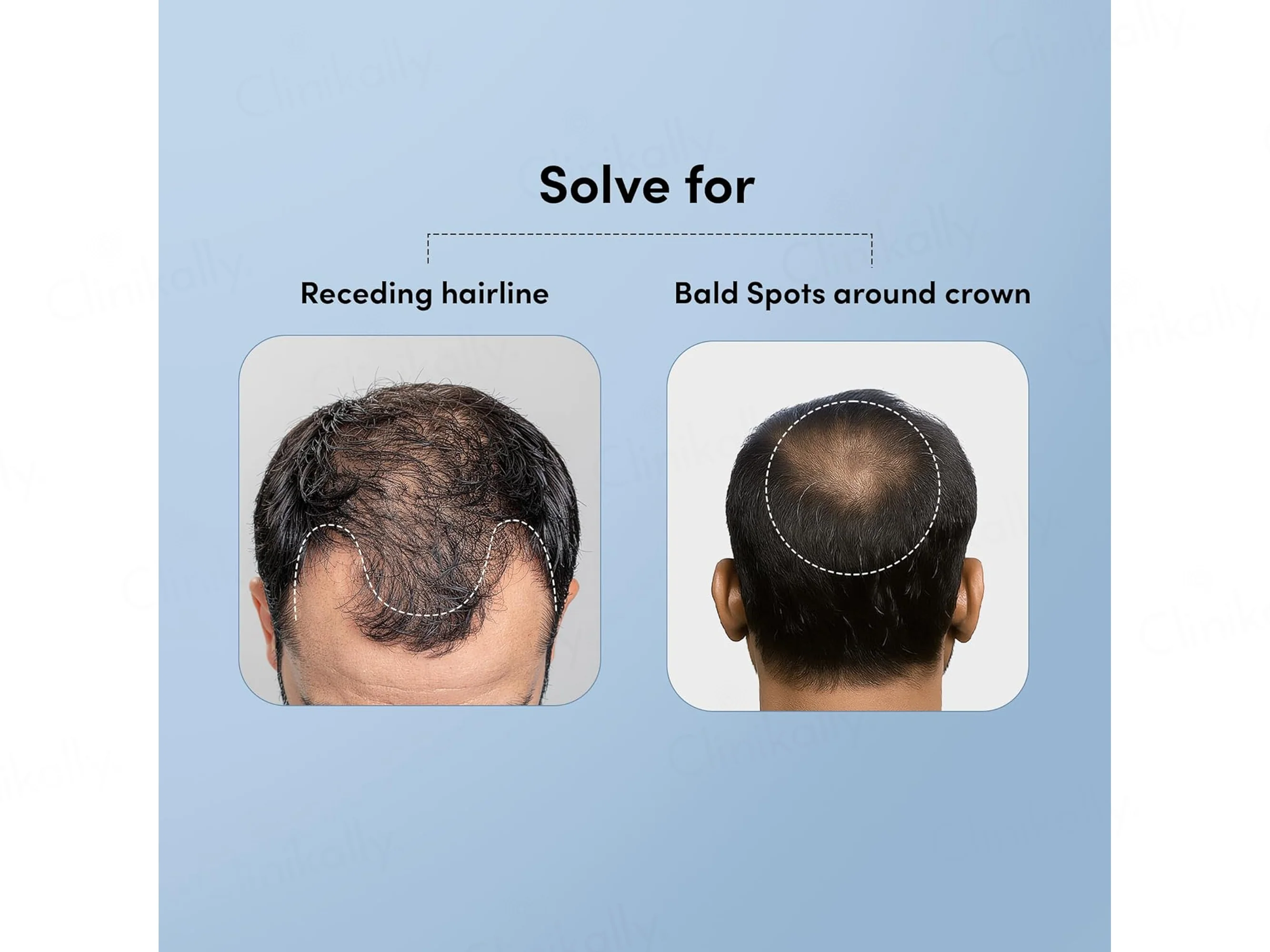 Man Matters Minoxifin Advance Hair Topical Solution - Image 3