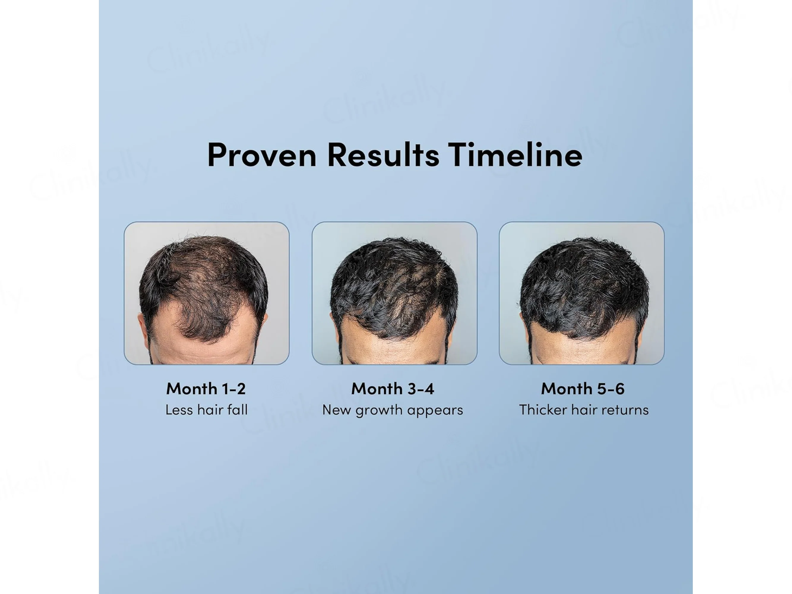 Man Matters Minoxifin Advance Hair Topical Solution - Image 5