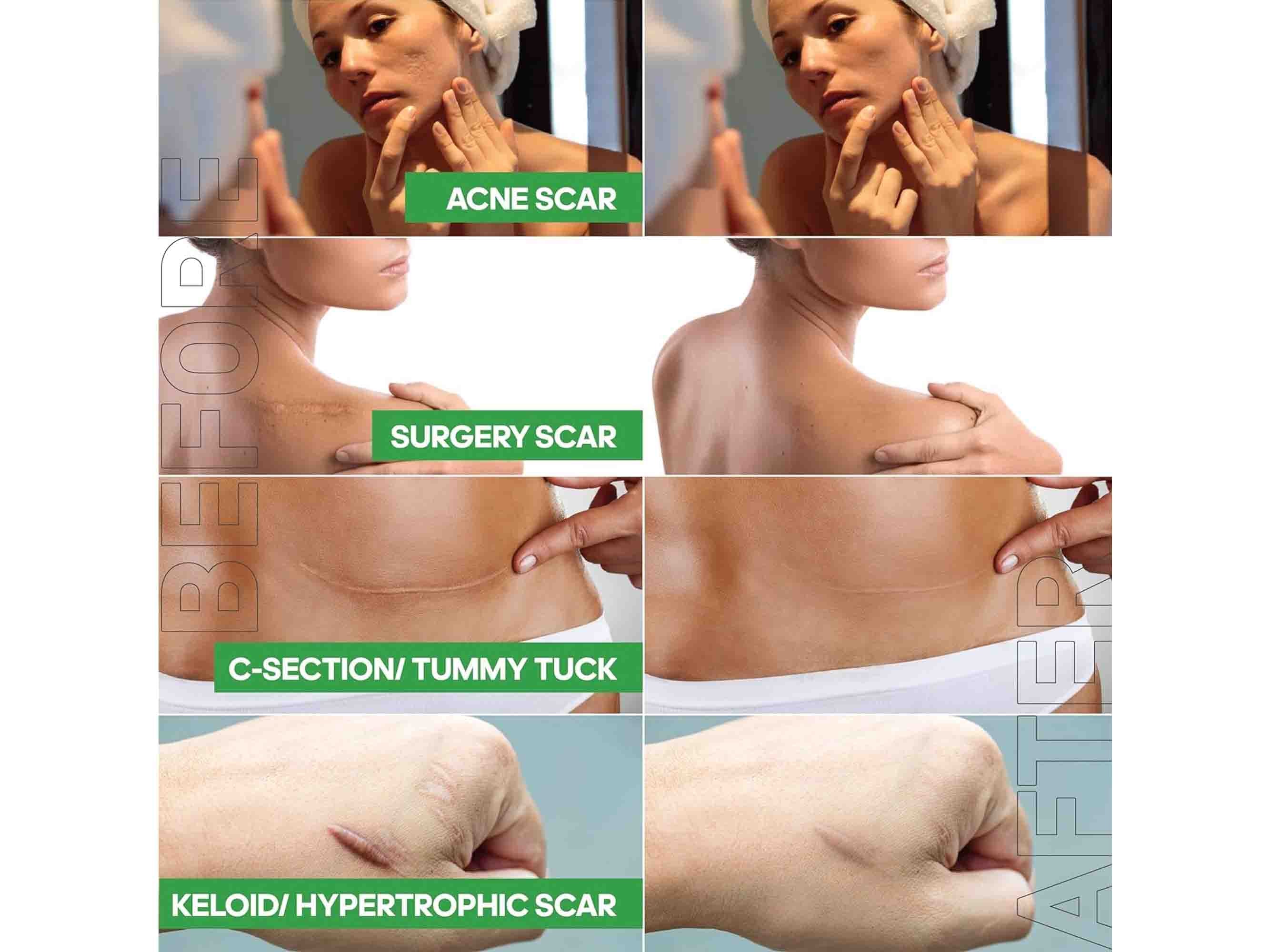 Mepiform Self-Adherent Soft Silicone Dressing For Scar Care - Image 6