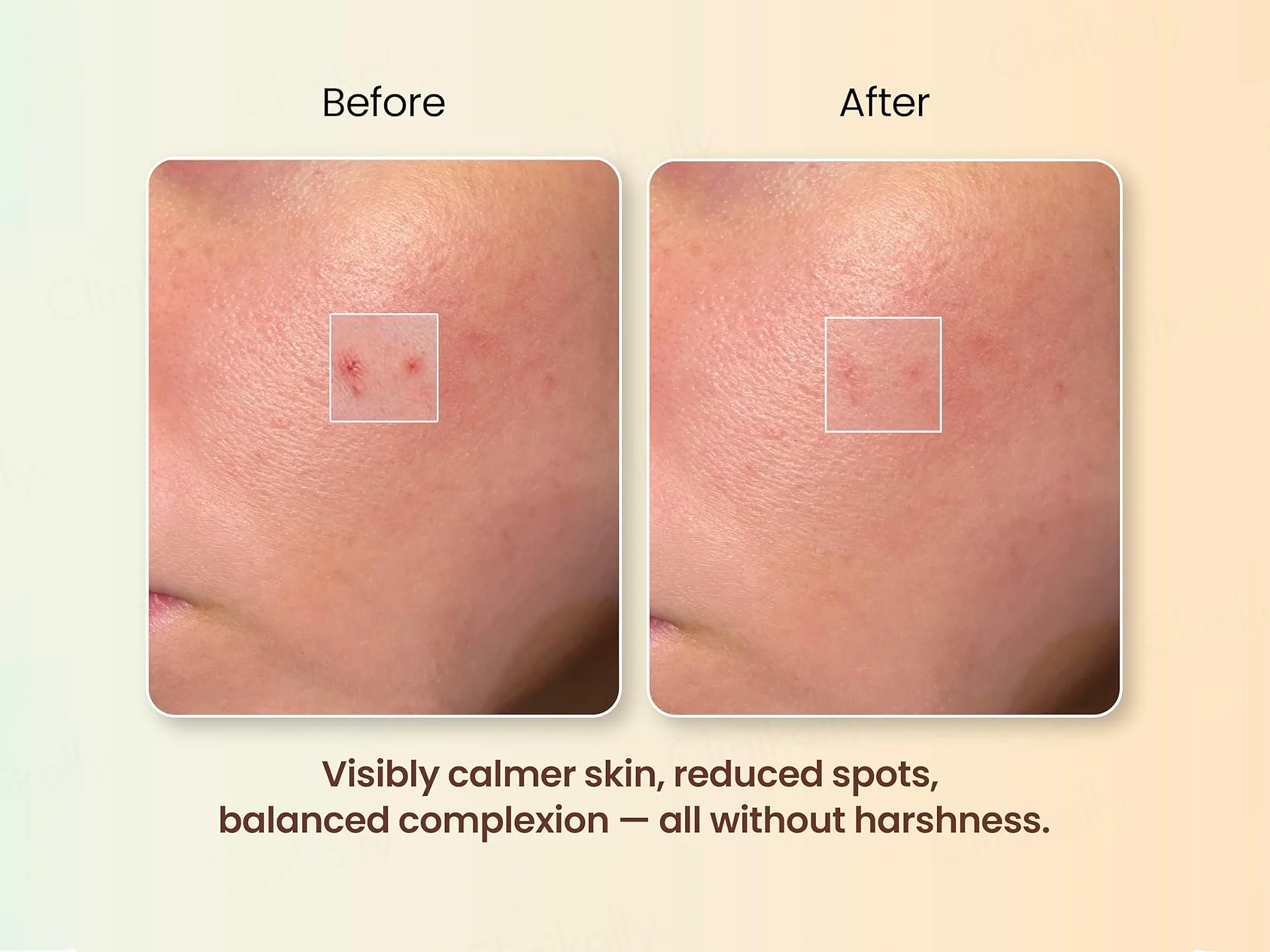 Moha: Spot Corrector Anti Acne Gel - Image 6