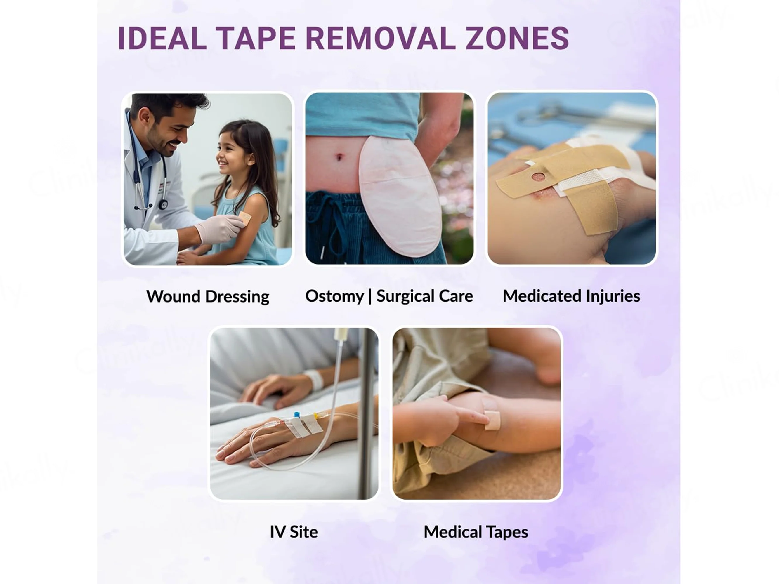 Soreze Cleanse Medical Adhesive Remover Spray - Image 5