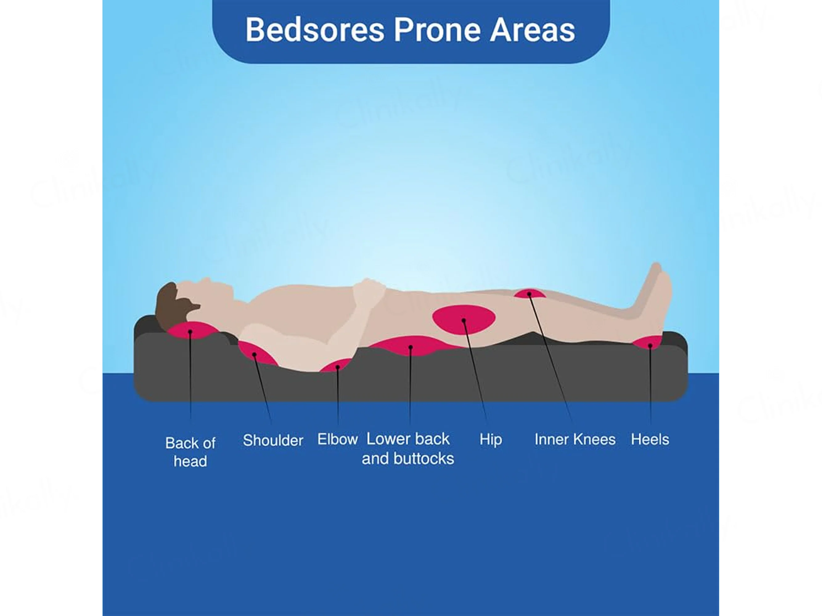 Soreze Silicone Barrier Gel - Image 9