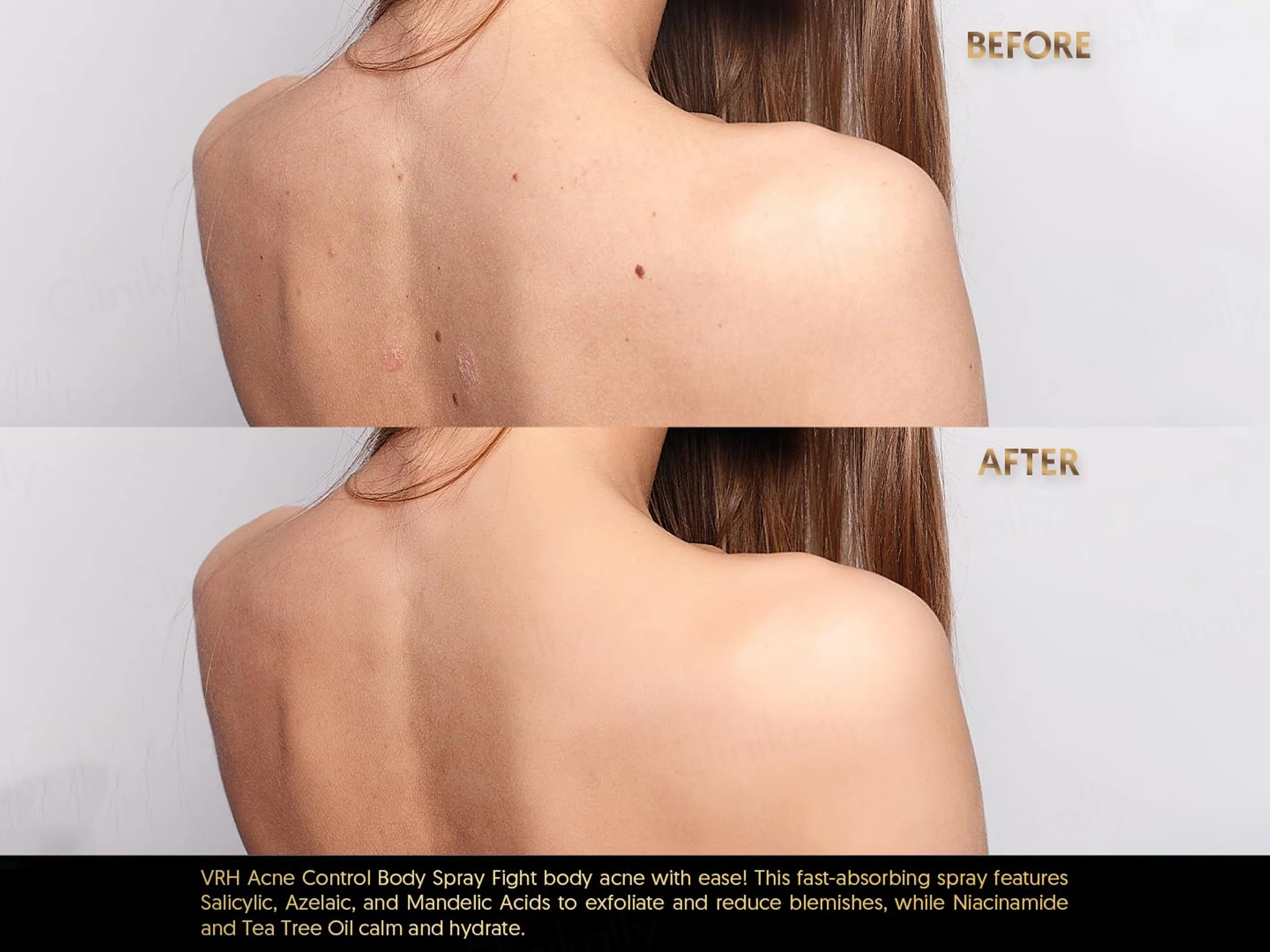 VRH Acne Clarify Therapy Body Spray - Image 4