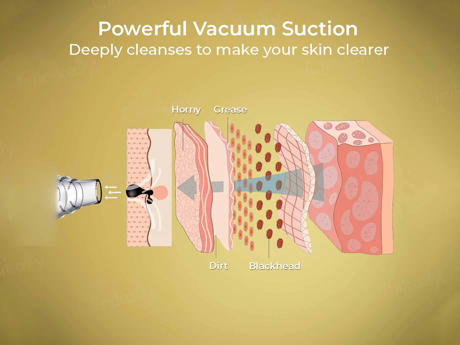 Winston Blackhead Remover - Image 4